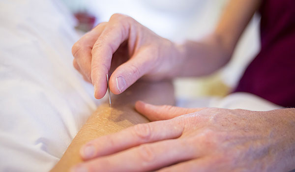 Acupuncture