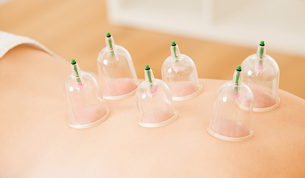 Cupping
